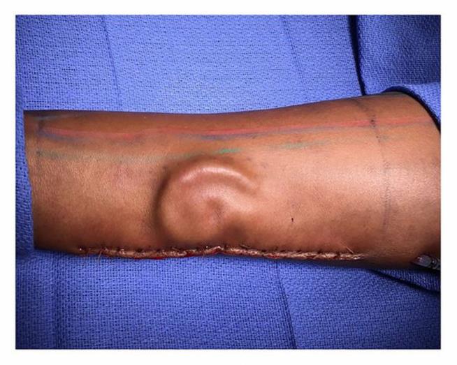 Army Surgeons Grow New Ear in Soldier's Forearm