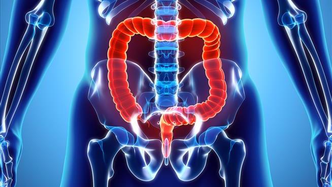 Don't Wait Till 50 for Your Colon Cancer Screening