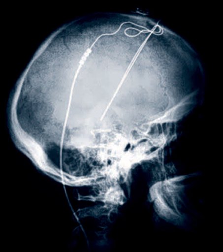 Brain Pacemakers May Revolutionize Treatment