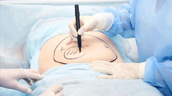 When It Comes to Cosmetic Surgery, Liposuction Is King