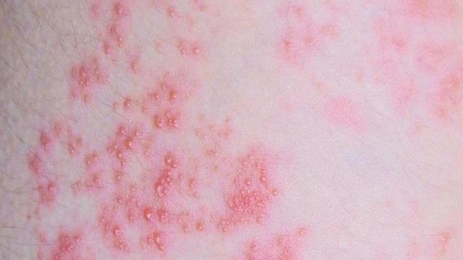 Whatever You Know About Shingles—It's Worse