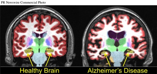 Brain Scans May Predict Alzheimer's
