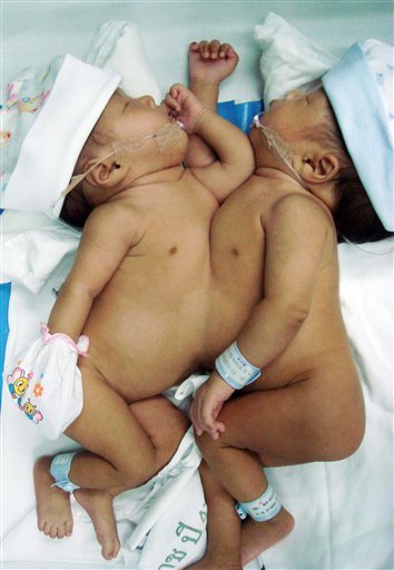 Conjoined Twins Are Freed
