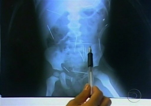 Docs Extract Life-Threatening Needles From Brazil Boy