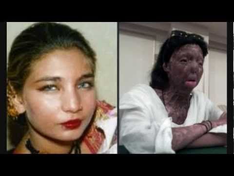 Pakistan Outrage Erupts After Acid Victim Suicide