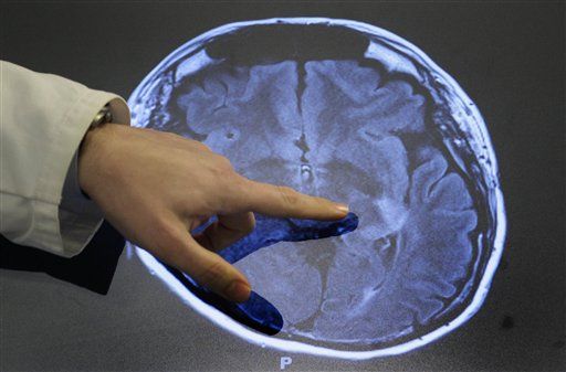Study Sees Link Between Concussions, Alzheimer's