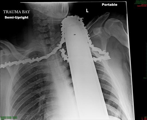 Guy Gets Chainsaw Stuck in Neck, Survives