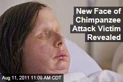 Chimp Attack Victim, Charla Nash Face Transplant: First Photos Revealed From Successful Surgery