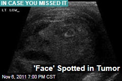 &#39;Face&#39; Spotted in Testicle Tumor