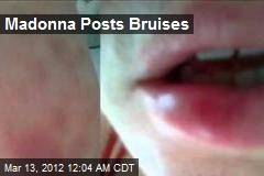 Madonna Posts Bruises