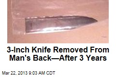 3-Inch Knife Removed From Man&#39;s Back&mdash;After 3 Years