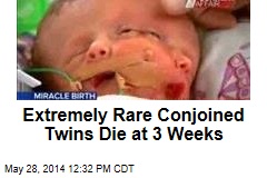 Extremely Rare Conjoined Twins Die at 3 Weeks
