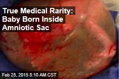 Baby Born 3 Months Early &mdash;Still Inside Amniotic Sac