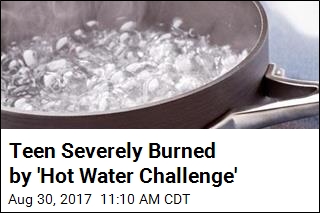 &#39;Hot Water Challenge&#39; Injures Sleeping Teen