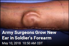 Army Surgeons Grow New Ear in Soldier&#39;s Forearm