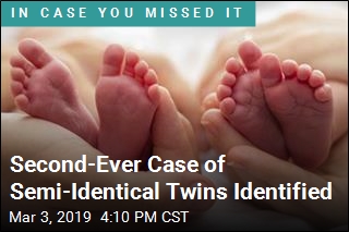 Second-Ever Case of Semi-Identical Twins Identified
