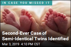 Second-Ever Case of Semi-Identical Twins Identified