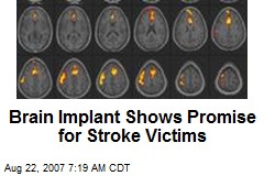 Brain Implant Shows Promise for Stroke Victims