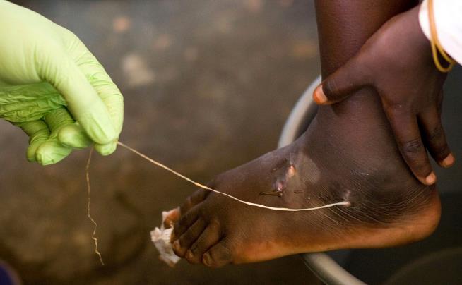 World creeps closer to eradicating human Guinea worm cases, with just 10 last year: Carter Center