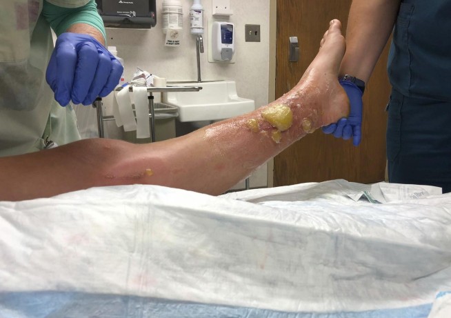 Poison parsnip causes severe burns, blisters on woman's legs