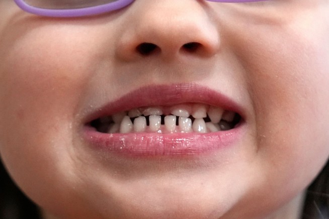 FDA restricts use of kids' fluoride supplements citing emerging health risks