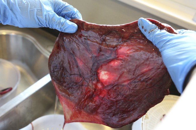 Oregon infant's illness prompts warning about placenta pills