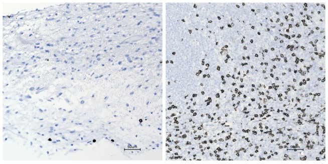 Unusual treatment shows promise for kids with brain tumors