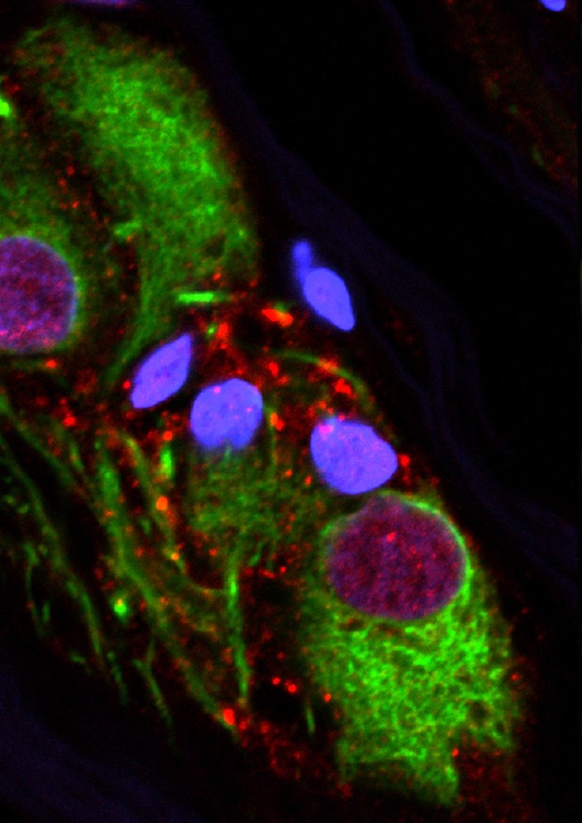 Appendix removal is linked to lower risk of Parkinson's