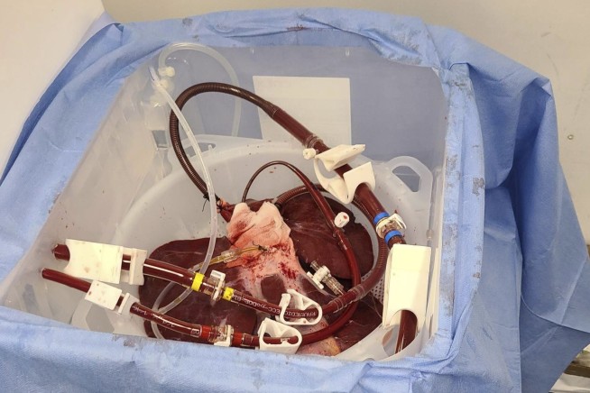 FDA OKs trial of pig livers as dialysis-like treatment for liver failure