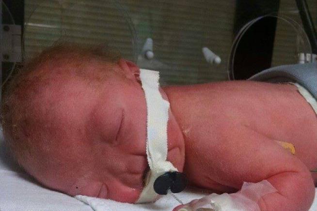 In Rarest of Cases, Baby Born Without a Nose