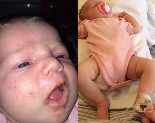 Mom: Newborn Could Have Died From a Kiss
