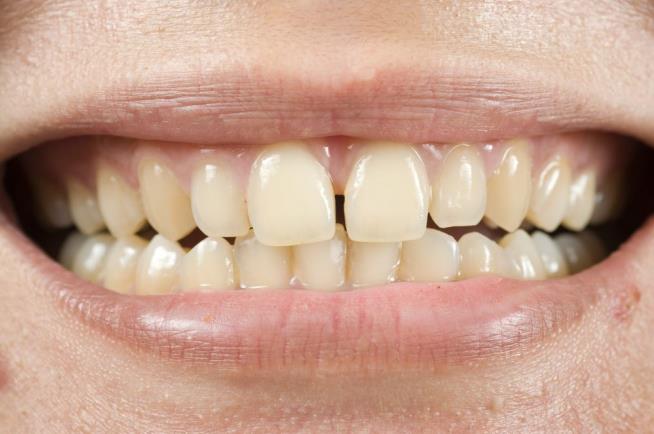 In Some Ways, Americans' Teeth Worse Than Brits'