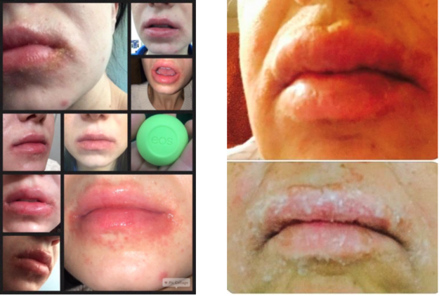 Lip Balm to the Stars Hit With Class-Action Lawsuit
