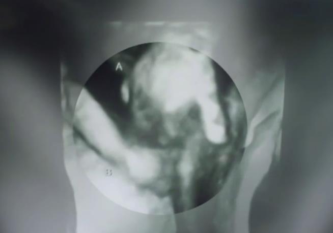 In Sonogram, Twin Appears to Clutch Dying Brother's Hand