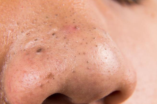 Meet the Doc Who Pops Pimples for the Internet's Enjoyment