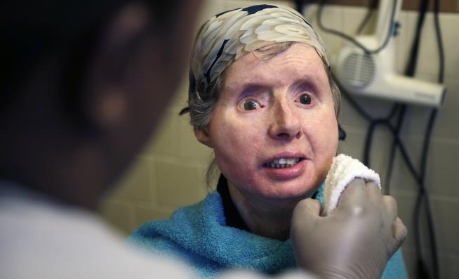 5 Years After Face Transplant, Body Rejecting Tissue
