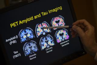 Experimental Alzheimer's Drug Zaps Brain Plaque
