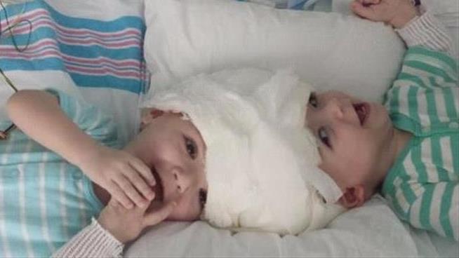 After Separation Surgery, Mom Holds Twin Alone for First Time