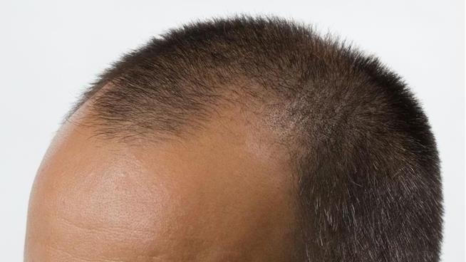 How 'Male Pseudo Hermaphrodites' Led to Under-FIre Hair-Loss Drug