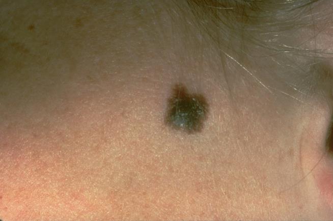 Skin Cancer Rates Drop in the Northeast