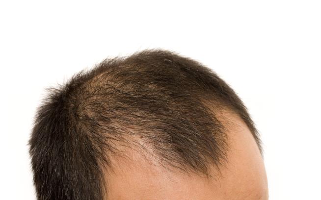 Genetic Test Could Predict Your Risk of Going Bald