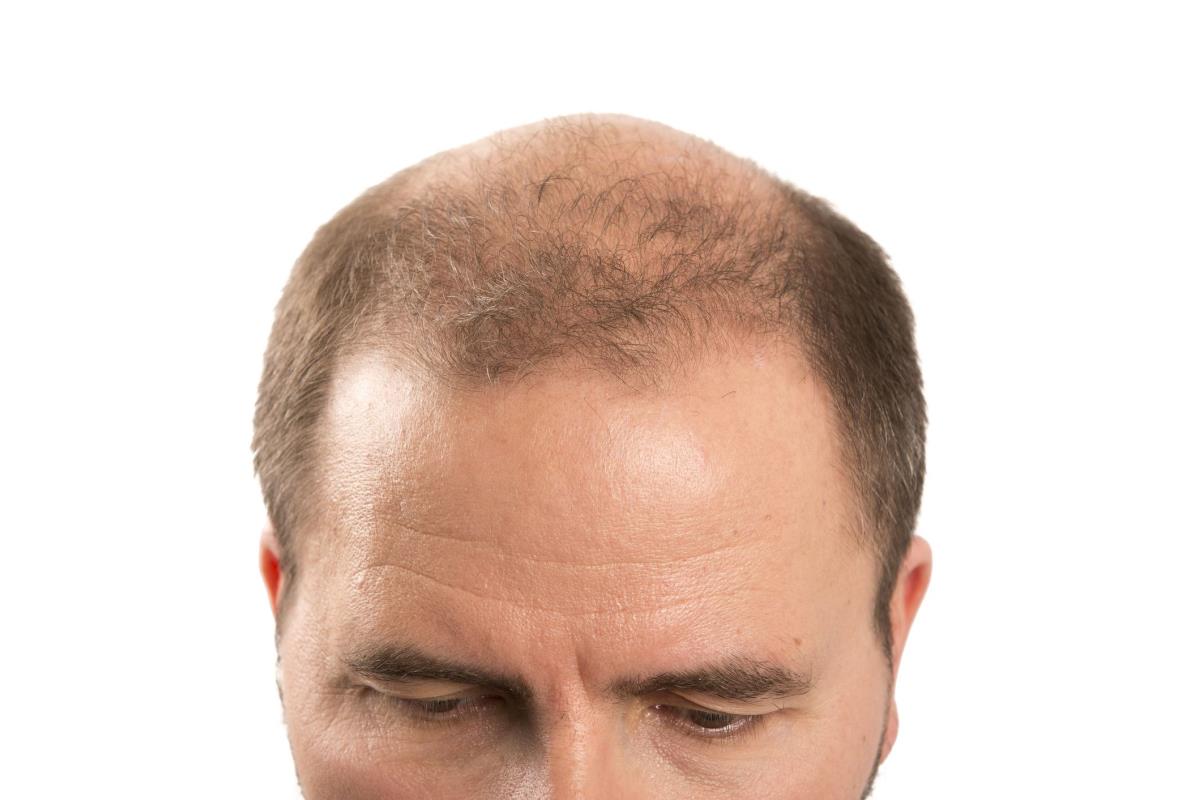 After Hair Loss Drug Came Years of Erectile Dysfunction