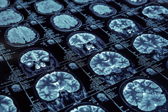 New Test Predicts When You're Likely to Get Alzheimer's