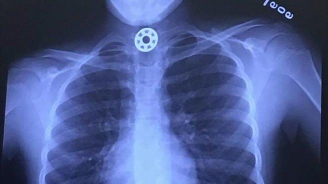 A Mom's Panic After Daughter Swallows Fidget Spinner Part