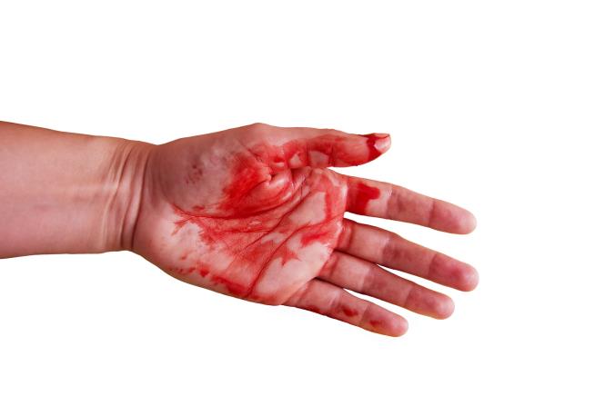 Woman Can't Stop Sweating Blood From Face, Hands