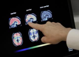 Researchers Explore New Alzheimer's Tack: Prevention