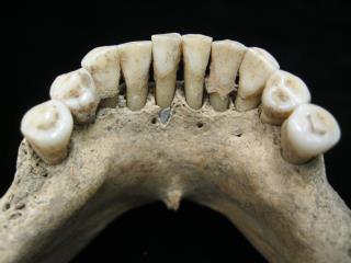 Flecks of Blue on Old Teeth Reveal a Medieval Surprise