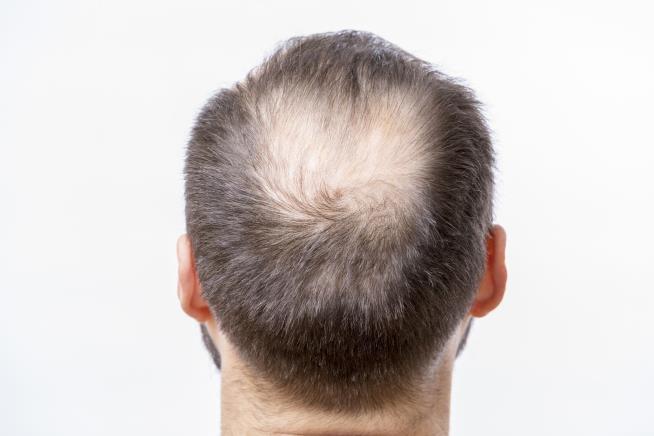 New Risk Factor for COVID-19: Baldness?