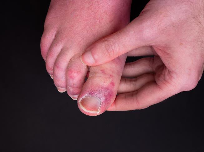 Researchers Unlock the Mystery of 'COVID Toe'