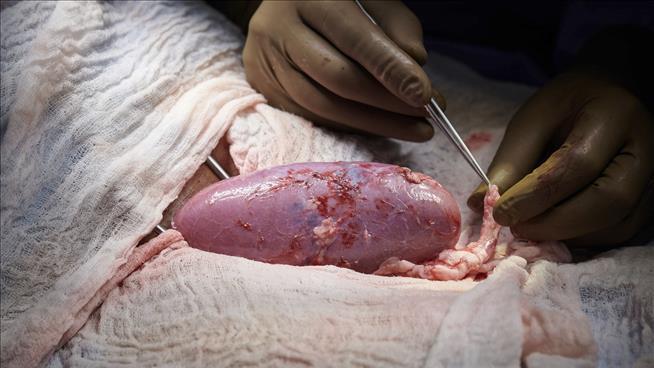 This Kidney Came From a Pig, and Worked in a Human